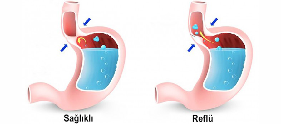 REFLÜ HASTALARI NASIL BESLENMELİ? reflu